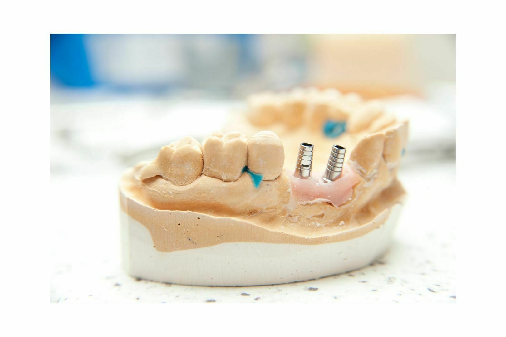 Modèle pour la construction de prothèses sur implants
