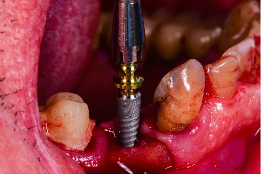 pose d'implant en l'absence de prémolaires mandibulaires