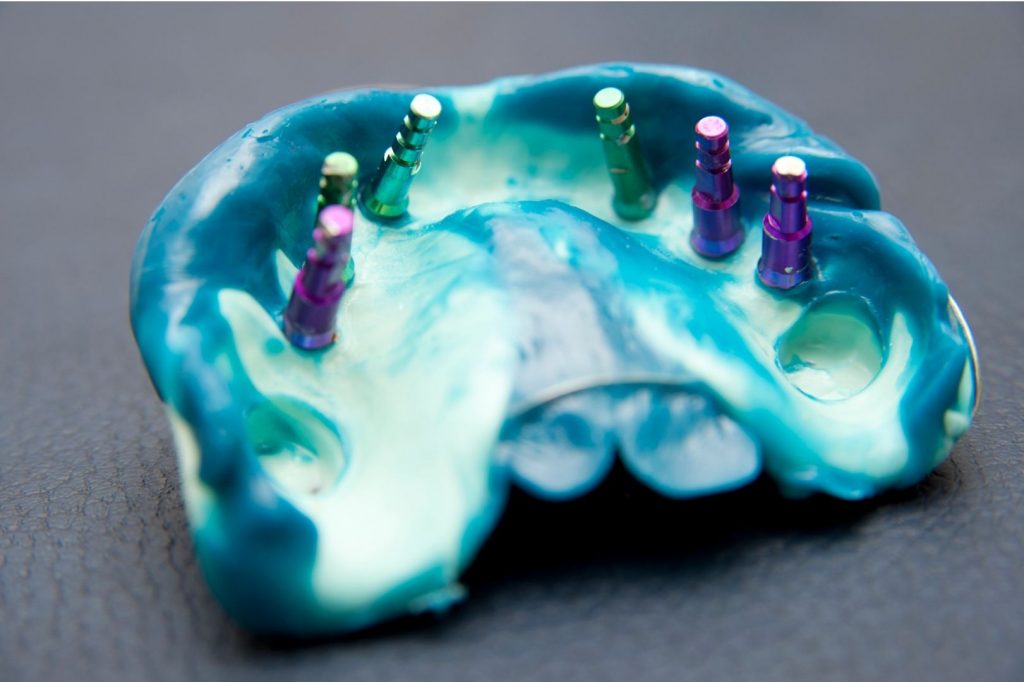 prise d'empreinte pour prothèse sur implant