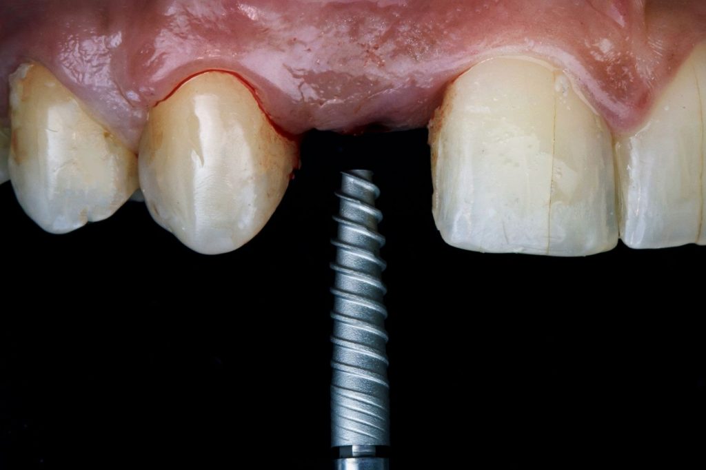 Pose d'implant en l'absence de l'incisive latérale supérieure