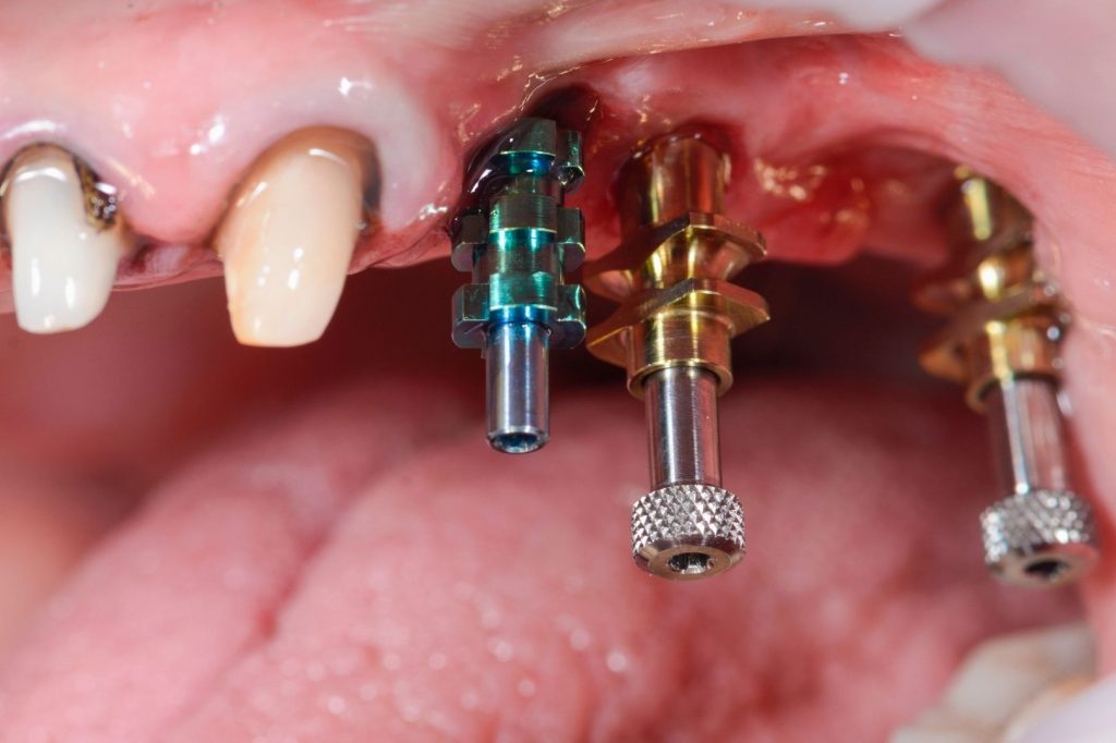 poste d'empreinte sur implant