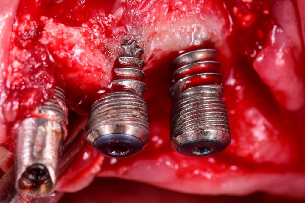 pose d'implant intra-osseux