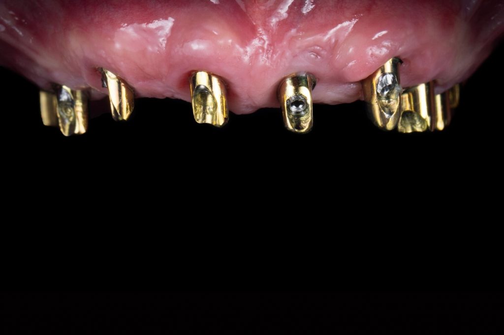 Pose d'implant chez un patient totalement édenté