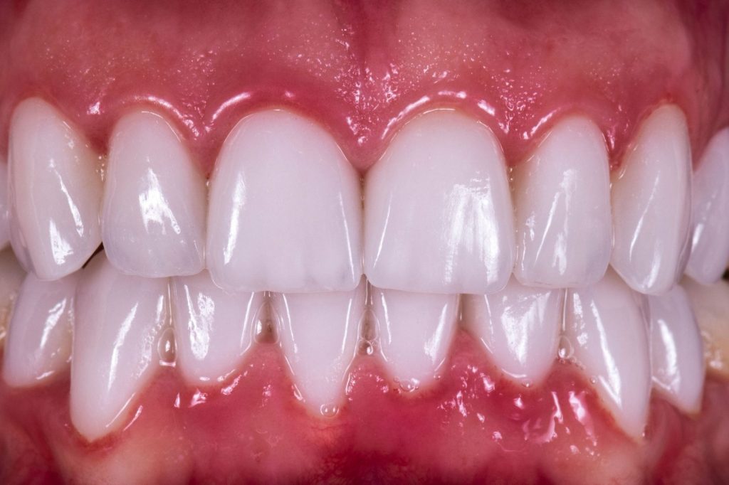 Prothèse post-implantaire dans les dents manquantes des incisives antérieures