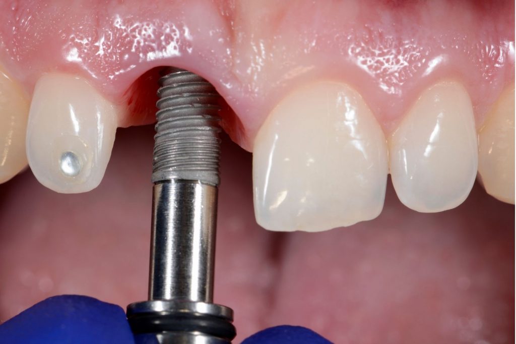 Implant en l'absence d'incisives antérieures