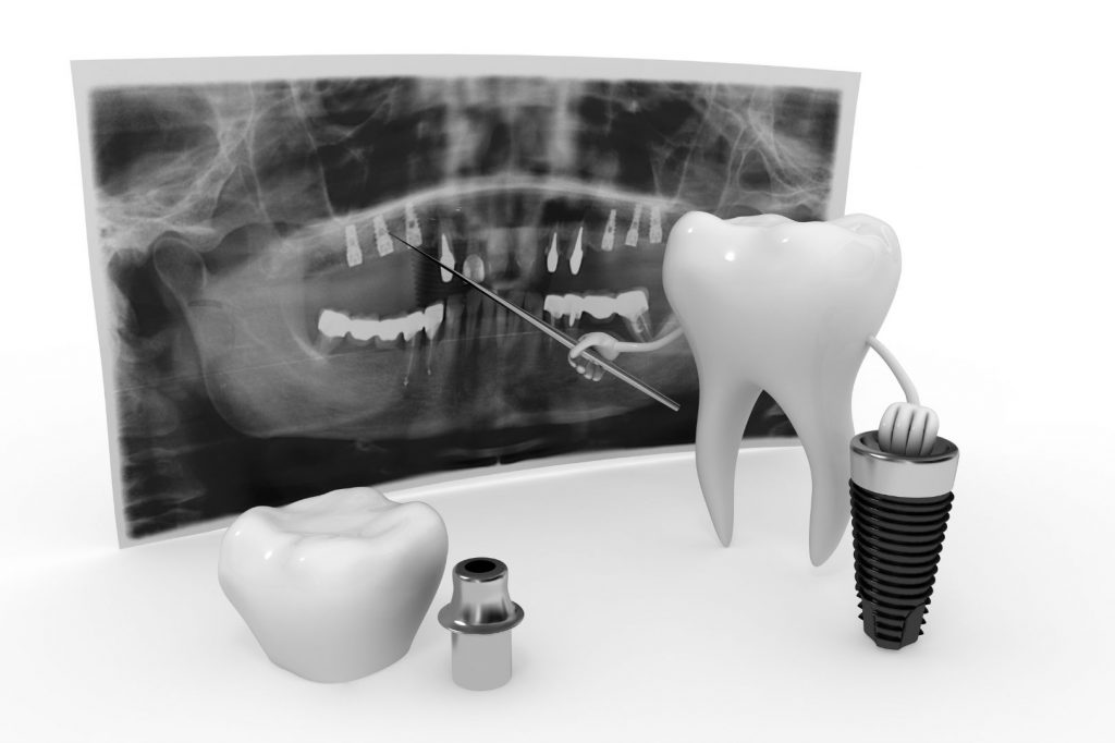 Qu'est-ce qu'un implant intra-osseux ?